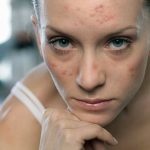 Beauty Products for Adult Acne 3 Beauty Products that Will Help You Cure Adult Acne